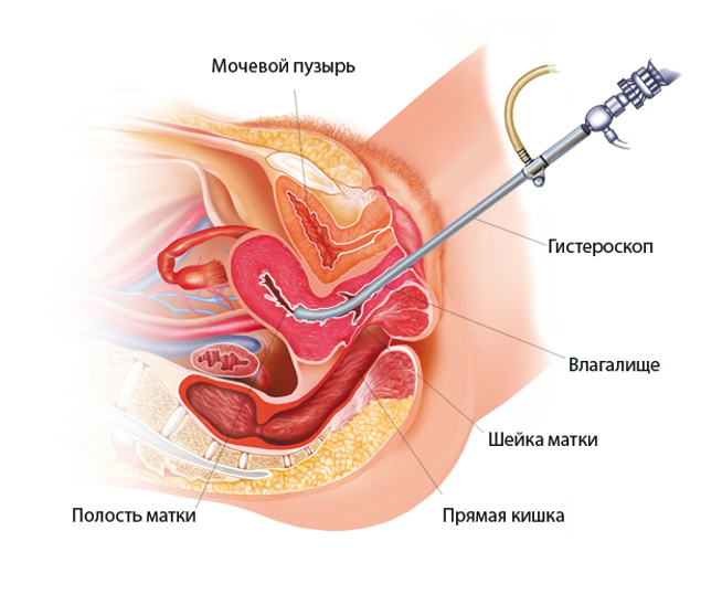 ГИСТЕРОСКОПИЯ